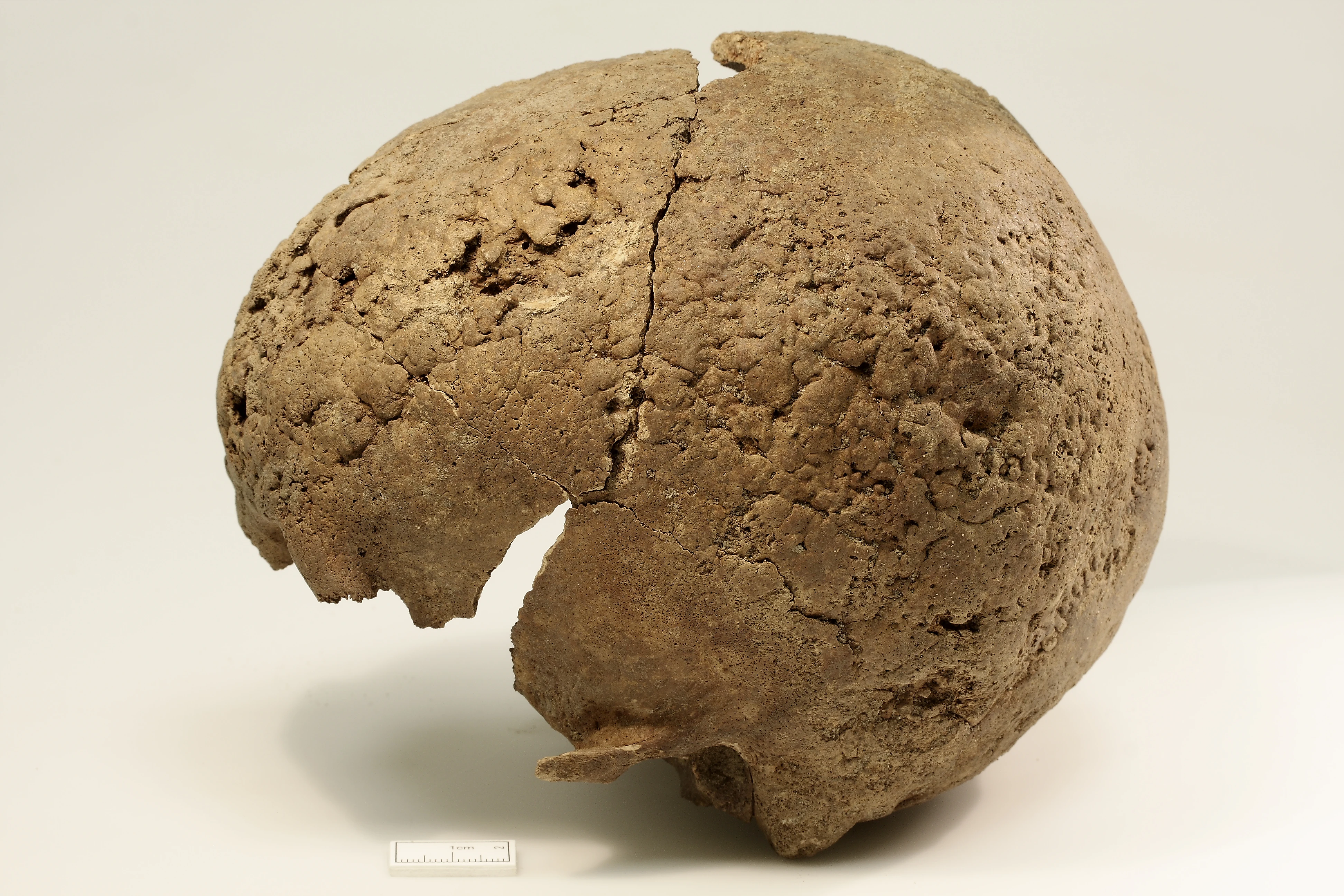 Pitting on the skull indicates tertiary syphilis, with advanced sclerotic healing