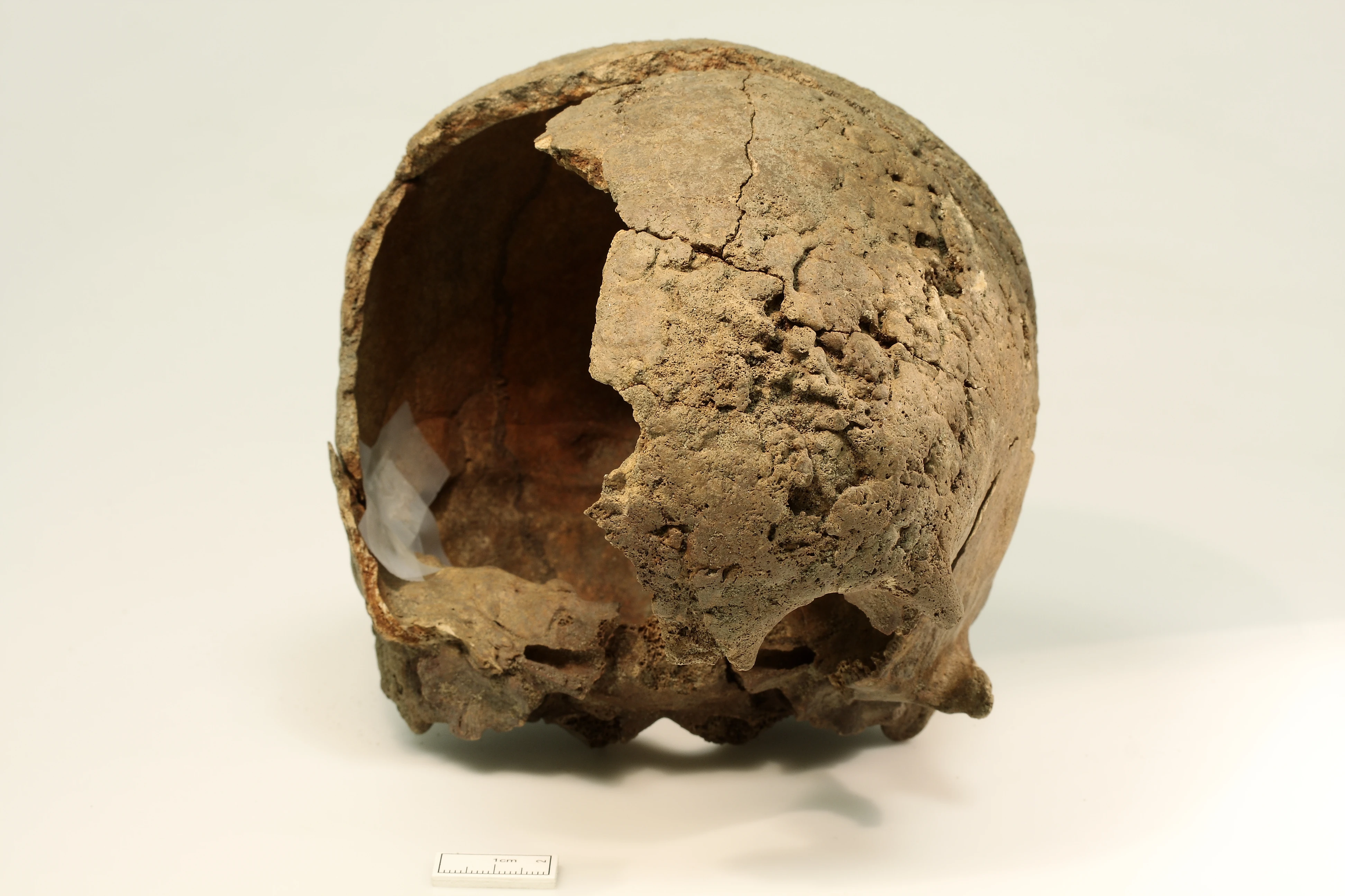 Caries sicca on the frontal bone of the skull, a sign of syphilis