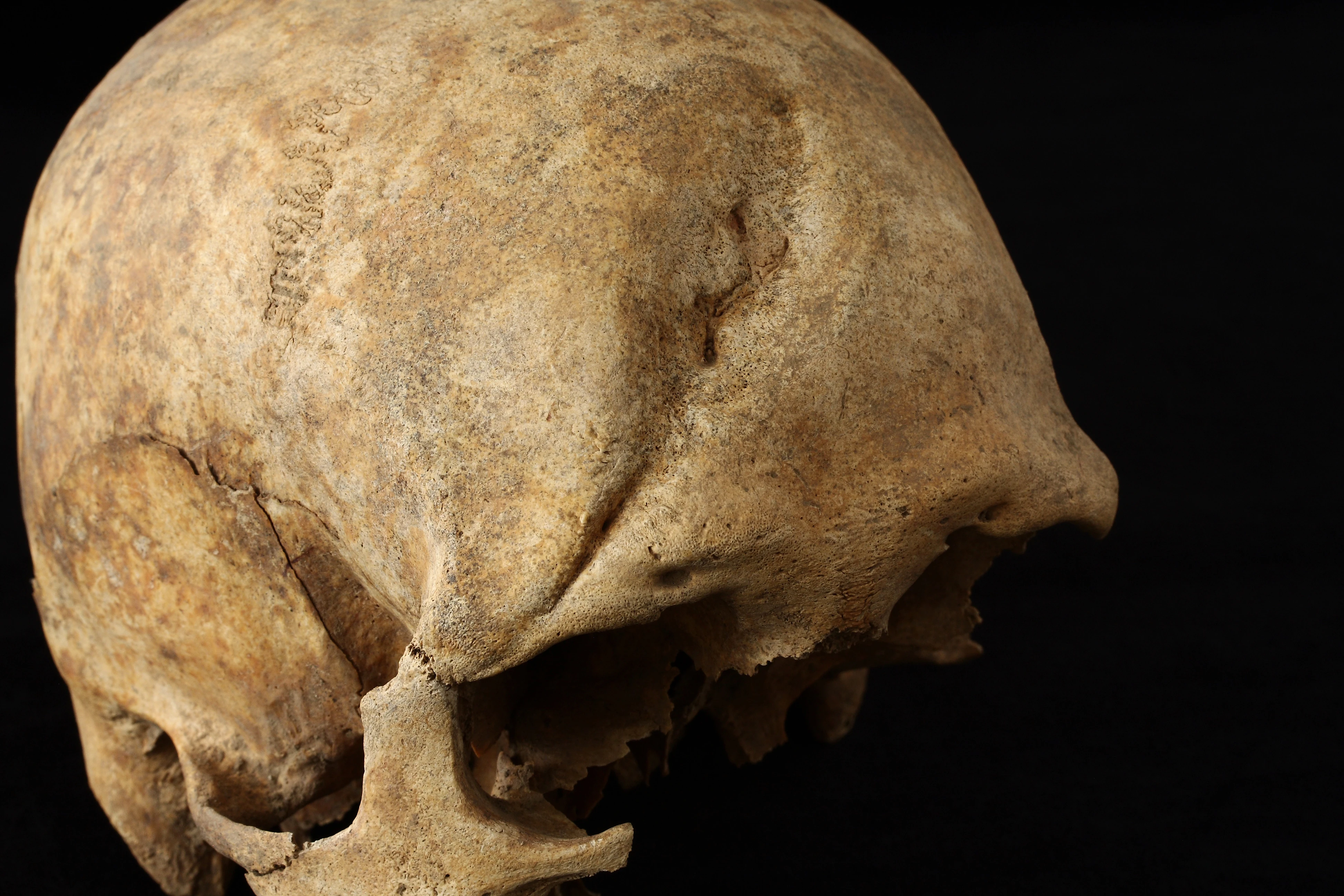 A skull showing a 'sharp force' injury on the forehead