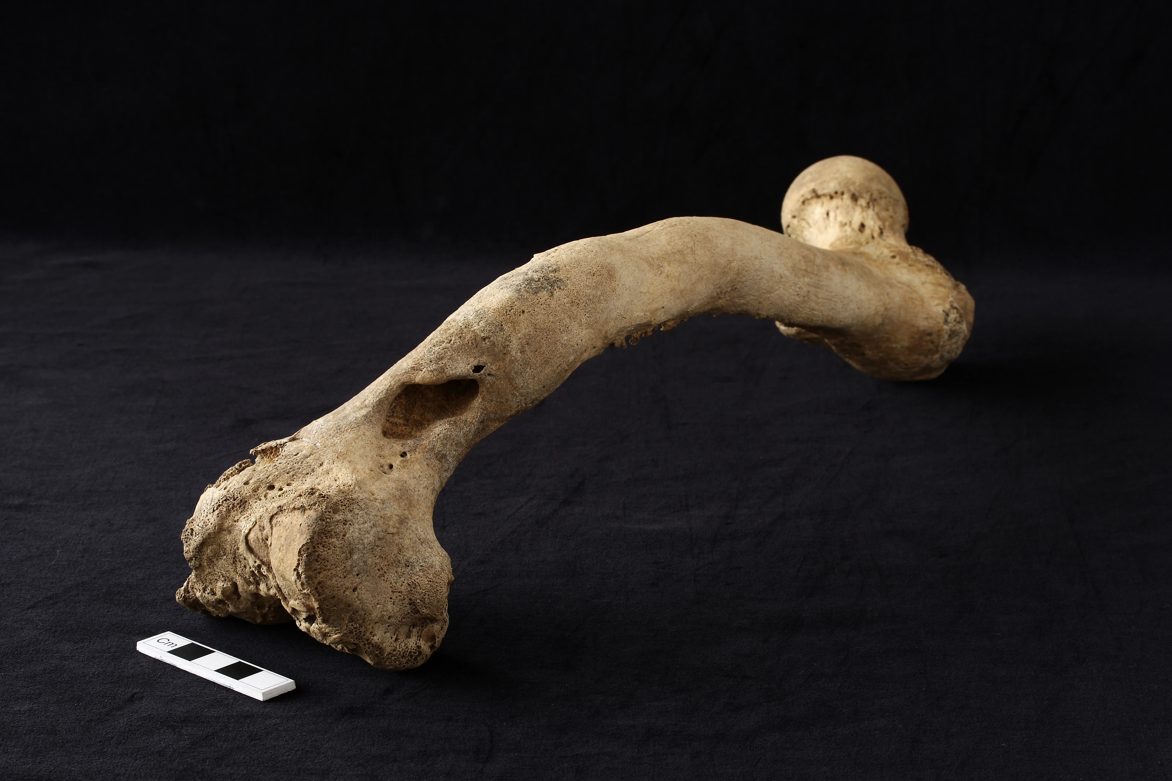 A right femur (thigh bone) disfigured by a fracture and subsequent severe infection